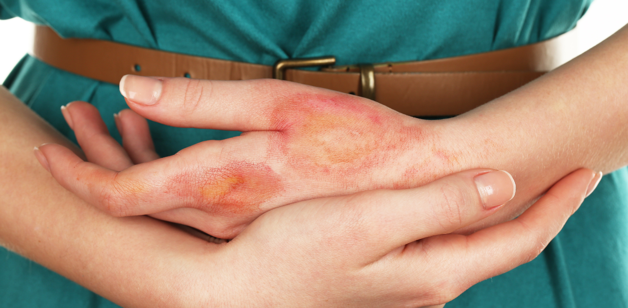 A close-up of a person’s hand with visible burns, held gently by the other hand