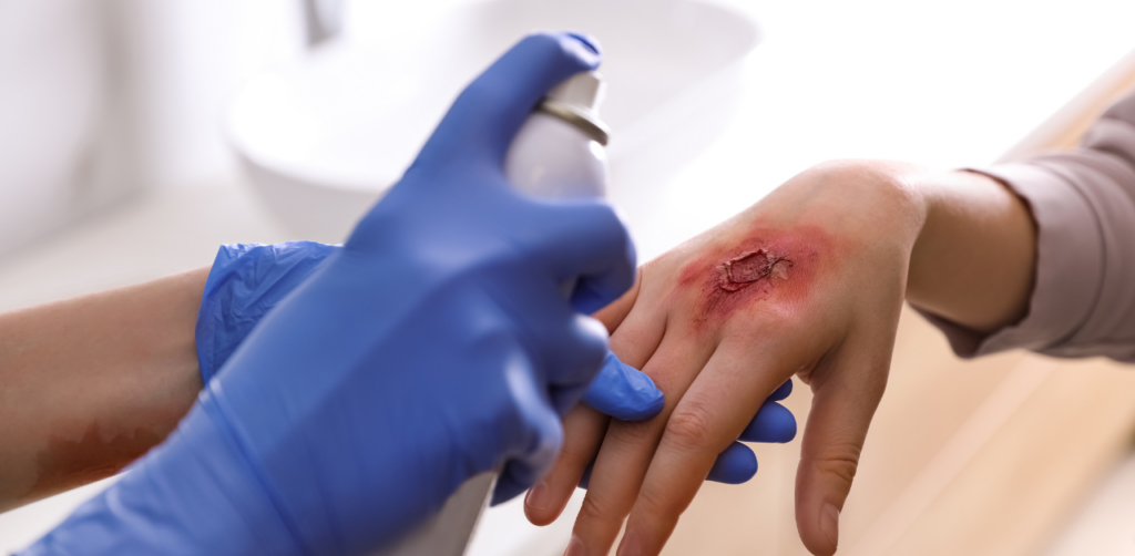 A gloved medical professional sprays an antiseptic on a deep wound on a person’s hand