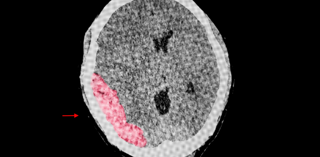 CT scan of a human brain highlighting a red area, indicating possible trauma or bleeding, with an arrow pointing to it