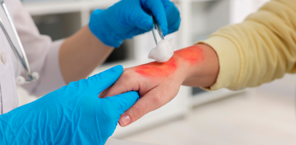 Medical professional treats a burn on a person’s hand, illustrating a possible personal injury insurance claim