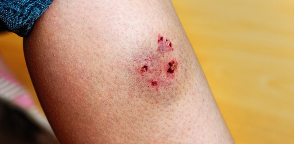 Close-up of a human leg showing a fresh, red dog bite wound with multiple punctures