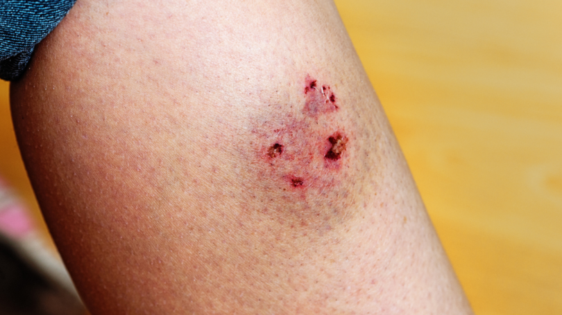 Close-up of a human leg showing a fresh, red dog bite wound with multiple punctures