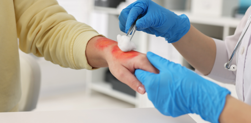 Medical professional treating a red, inflamed burn wound on a person’s hand with cotton and tweezers