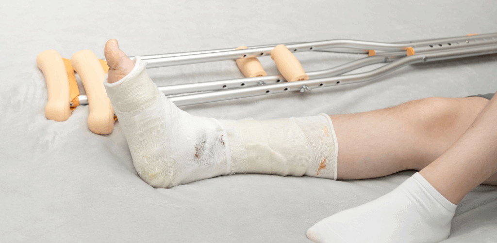 Injured foot in a white plaster cast with crutches lying beside it on a light surface